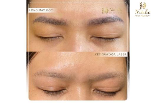 xoa-xam-long-may (3)